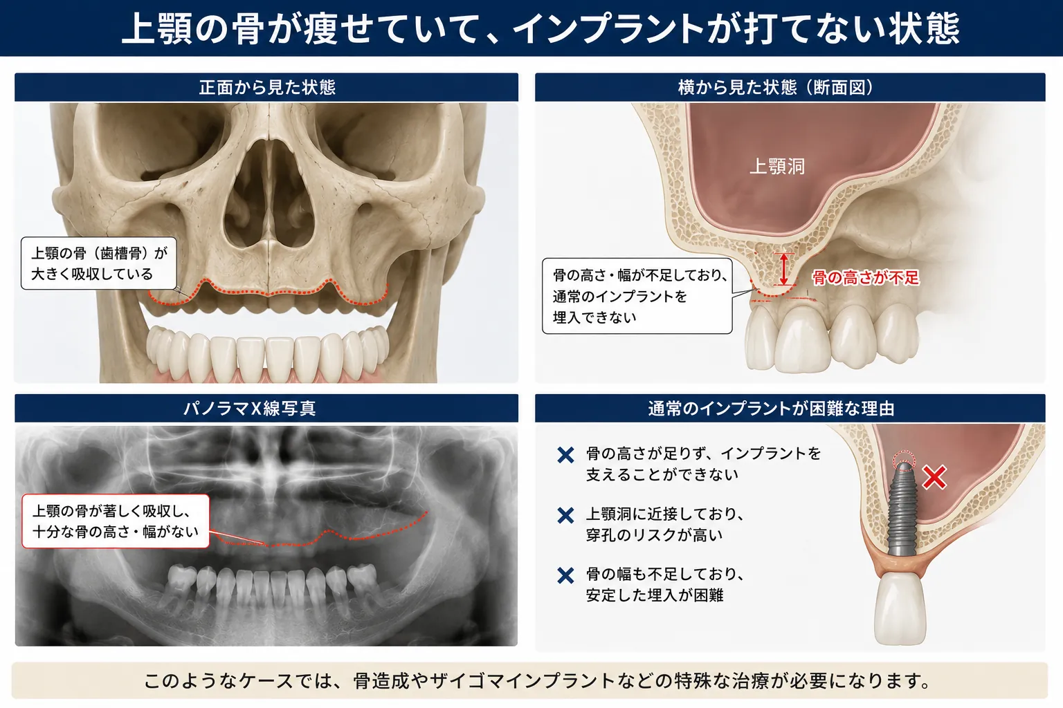 01 上顎の骨が少ない状態の説明用の図